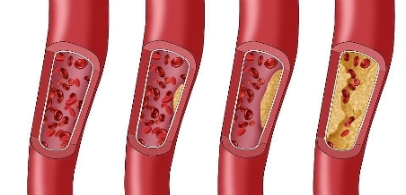 阿托伐他汀是治什么的?优选原研药、长期使用,有效降脂第一步