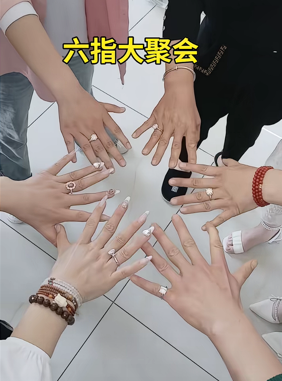 女子长12根手指自称灵活好用：吸粉超百万成大网红(图3)